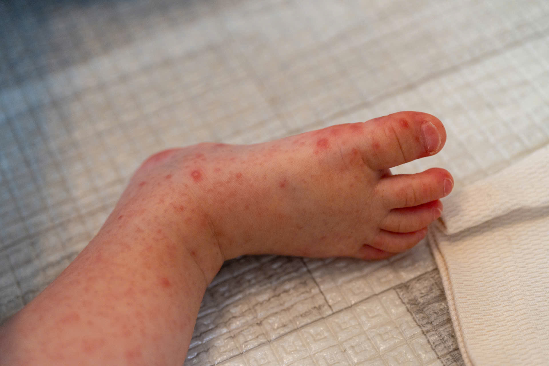 Ngành y tế khuyến cáo cần tiêm đủ 2 liều vacxin Sởi - Rubella cho trẻ từ 1-10 tuổi. Ảnh: VNVC.