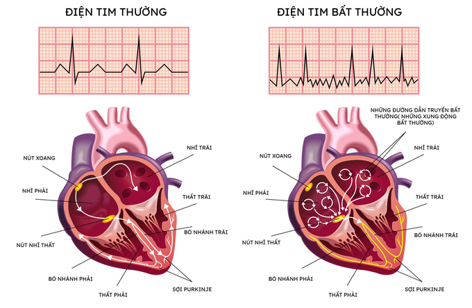 Rung nhĩ là rối loạn nhịp tim thường gặp nhất. Bệnh nhân mắc rung nhĩ có nguy cơ đột quỵ cao gấp 5 lần người bình thường.