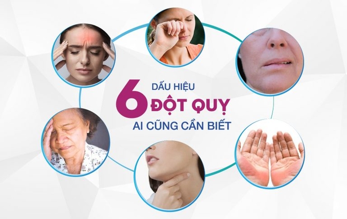 Cần nhận biết sớm các dấu hiệu của bệnh đột quỵ. Ảnh minh họa