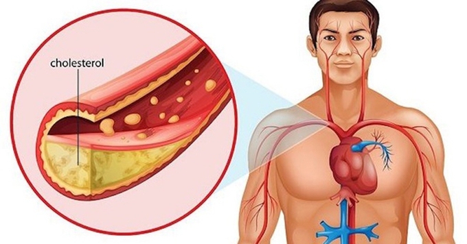 Mỡ máu cao chính là một yếu tố làm xơ vữa, cứng, hẹp, tắc nghẽn động mạch não, mạch vành tim, dẫn đến nguy cơ cao mắc bệnh tim, đột quỵ.