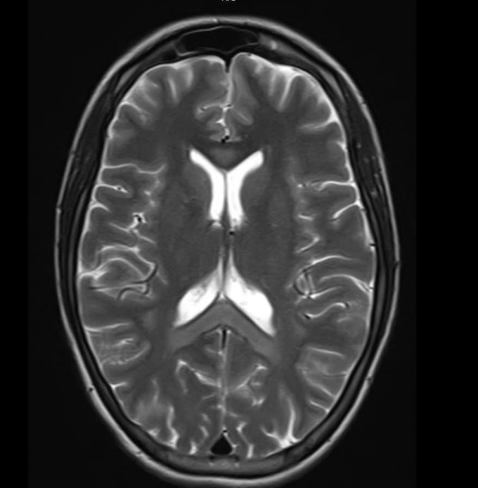 Hình ảnh chụp MRI sọ não bệnh nhân nữ bị tổn thương lan tỏa hai bán cầu và thể chai. Ảnh: Bệnh viện cung cấp.