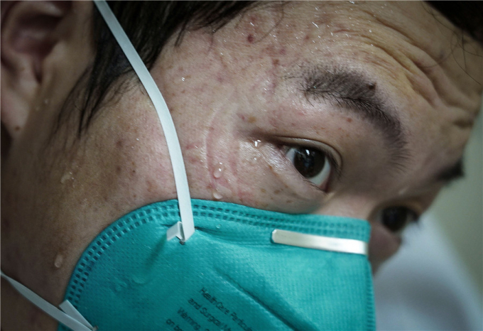 Một y tá của Bệnh viện số 1 - Đại học Nam Xương (Trung Quốc) mang khẩu trang bị hằn vết trên khuôn mặt sau một ca làm việc. Ảnh: THX
