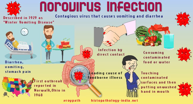 Thế giới từng xảy ra các đợt bùng phát norovirus có liên quan đến nguồn nước và thực phẩm bị ô nhiễm (phổ biến trên hải sản tươi sống như hàu) bị nhiễm bệnh và lây lan từ người sang người. Đồ họa: histopathology.net