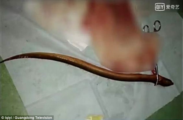 Hình ảnh con lươn dài gần nửa mét được lấy ra khỏi ổ bụng bệnh nhân. Ảnh: DM