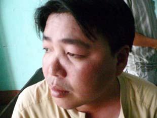  Mặt phóng viên Minh Phong bị sưng sau khi bị đánh.