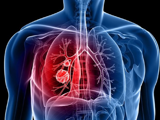 Nghiên cứu lâm sàng cho thấy sự kết hợp của xạ trị và hóa trị đồng thời cho kết quả tỷ lệ sống cao hơn ở bệnh nhân ung thư phổi (Ảnh minh họa).