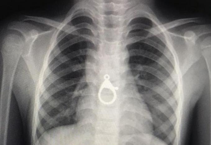 Hình ảnh chụp X-quang chiếc móc khóa nằm trong lồng ngực cháu H. Ảnh: Bệnh viện cung cấp.