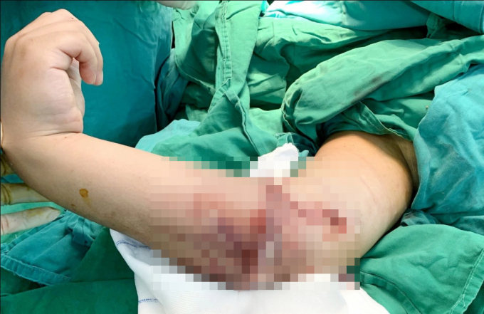 Cẳng tay bị đứt lìa đã được các bác sĩ Bệnh viện Nhi đồng 2 nối thành công bằng kỹ thuật vi phẫu. Ảnh: Bệnh viện cung cấp.