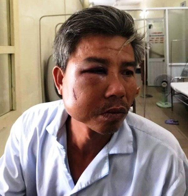 Ông Lê Song Toàn phải nhập viện với đa chấn thương sau khi bị hành hung. Ảnh: D.N.