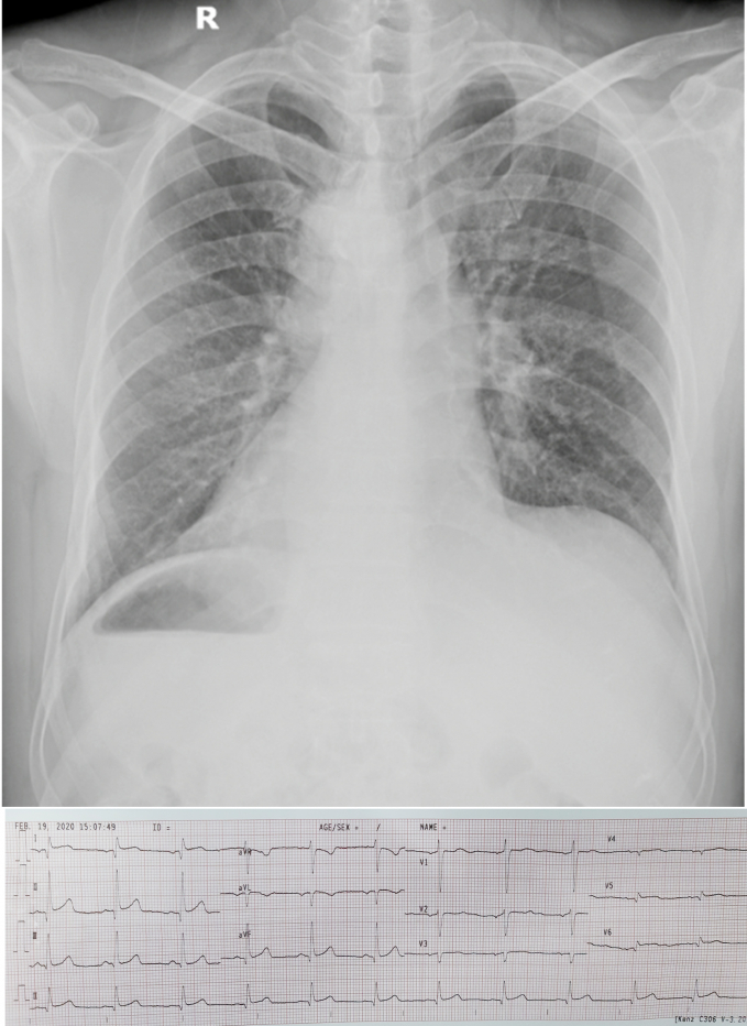 Hình ảnh X-quang phổi và ECG cho thấy tim bệnh nhân nằm bên phải. Ảnh: Bệnh viện cung cấp.