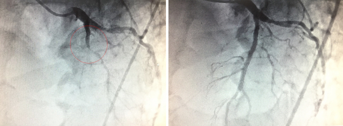 Hình ảnh chụp DSA cho thấy nhánh động mạch liên thất trước bị tắc và tái thông sau khi đặt stent. Ảnh: Bệnh viện cung cấp.