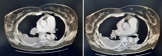 Hình ảnh CT scan ngực có cản quang của người bệnh. Ảnh: Bệnh viện cung cấp.