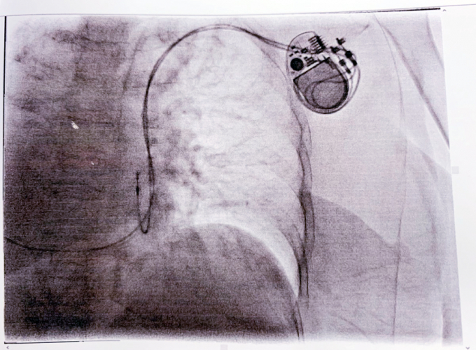 Hình ảnh máy tạo tạo nhịp tim đã được đặt cho người bệnh. Ảnh: BVCC.