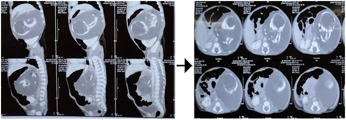 Hình ảnh CT khối u to sau phúc mạc. Ảnh: Bệnh viện cung cấp.