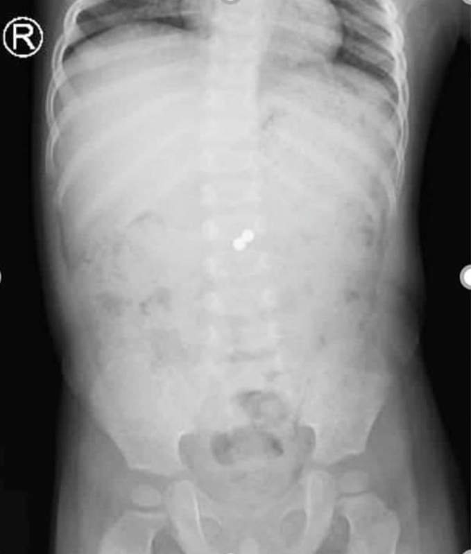 Hình ảnh viên bi hít chặt nhau trong ruột bé trai qua phim chụp x-quang. Ảnh: Bệnh viện cung cấp.