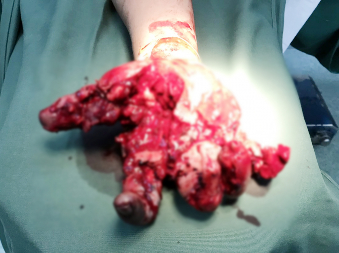 Bệnh nhân bị dập nát bàn tay, mất ngón tay trỏ do sử dụng pháo nổ. Ảnh: Bệnh viện cung cấp.
