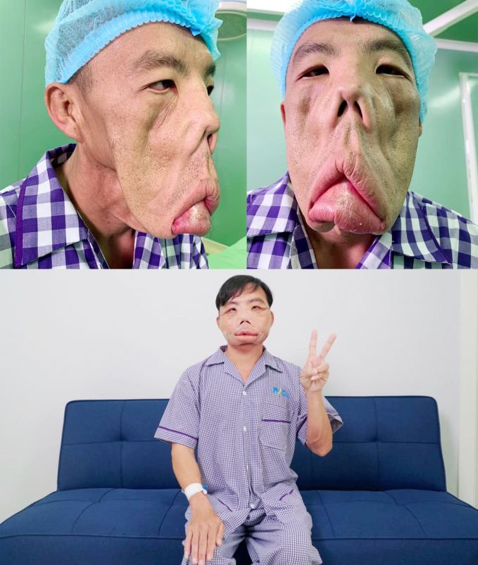 Bệnh nhân Lê Văn Mến trước và sau khi được các bác sĩ tìm ra căn bệnh hiếm gặp MRS, trải qua 3 cuộc đại phẫu. Ảnh: Bệnh viện cung cấp.
