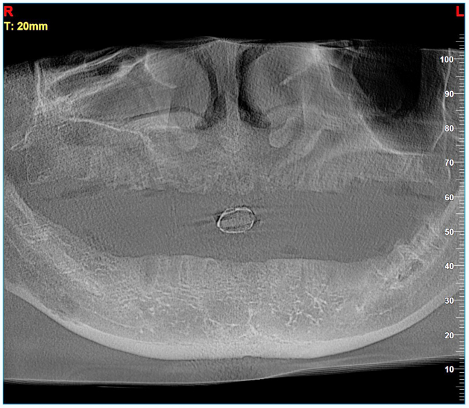 Hình X-quang của anh T. bị mất răng trầm trọng vì cầu răng sứ.