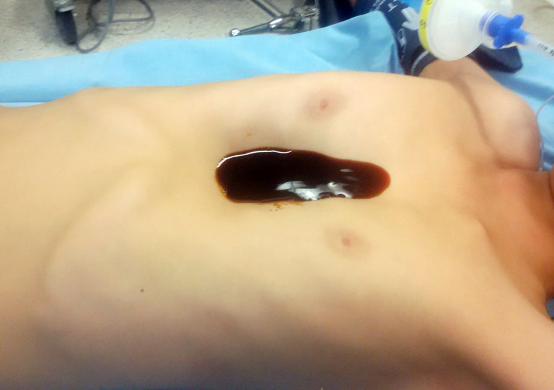 Bác sĩ xác định vết lõm trước khi phẫu thuật đặt thanh nâng ngực 2 năm trước. Ảnh: Bệnh viện cung cấp.
