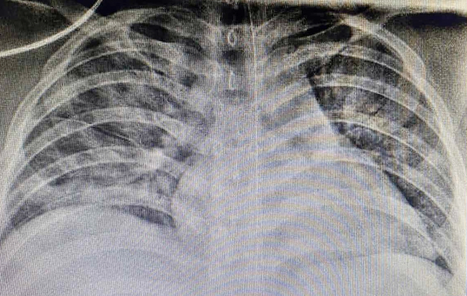 X-quang ngực cho thấy, hình ảnh tổn thương thâm nhiễm phổi nặng lan tỏa 2 phế trường. Ảnh: BVCC.