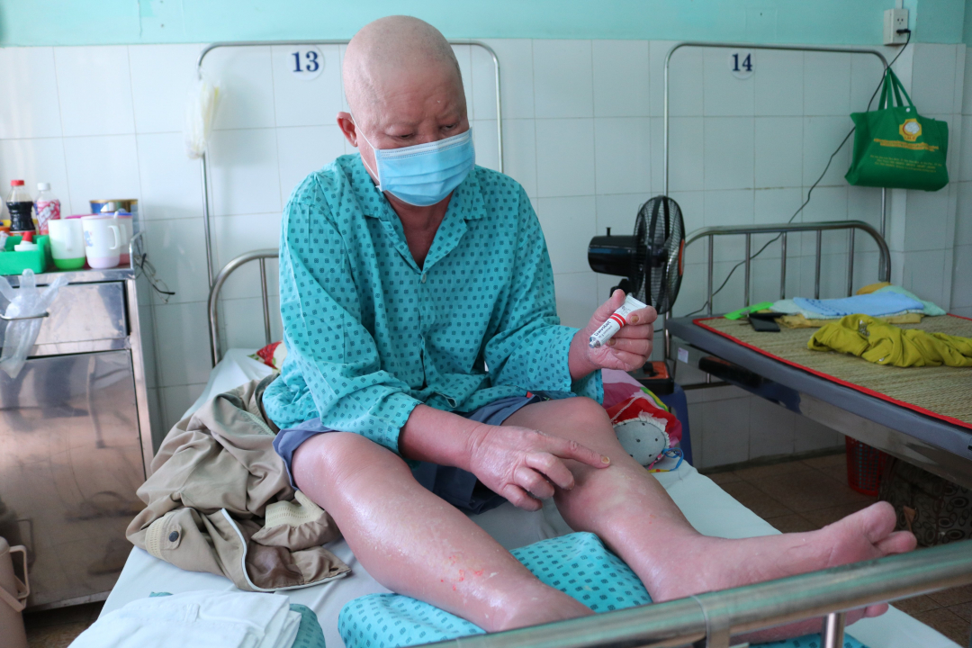 Một bệnh nhân bị vảy nến khởi phát đang điều trị tại Bệnh viện Da Liễu TP.HCM. Ảnh: Bệnh viện cung cấp.