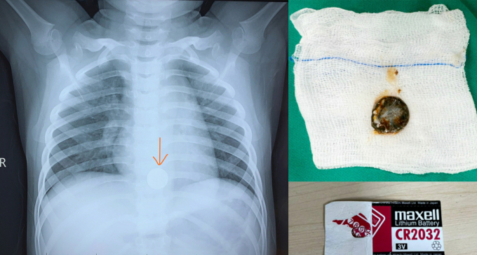 Hình ảnh phim chụp x-quang cục pin trong thực quản bé trai và cục pin được các bác sĩ lấy ra khỏi thực quản. Ảnh: Bệnh viện cung cấp.