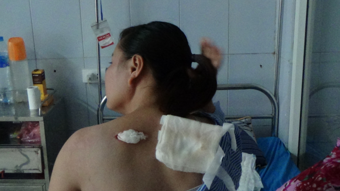 Lưng của bệnh nhân Nguyễn Thị Liên bị hoại tử. Ảnh: Thái Sơn.