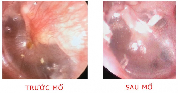 Hình ảnh nội soi trước mổ và sau mổ cholesteatoma và tạo hình xương con thì 2. Ảnh: BVCC.