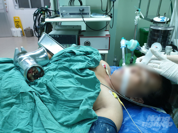 Bệnh nhân Nguyễn Trọng P. T, sinh năm 1988, ở tỉnh Bạc Liêu được đưa đến Bệnh viện Đa khoa Trung ương Cần Thơ cấp cứu trong tình trạng đau nhức dữ dội do bàn tay phải bị cuốn vào máy xay cá. Ảnh: BVCC.