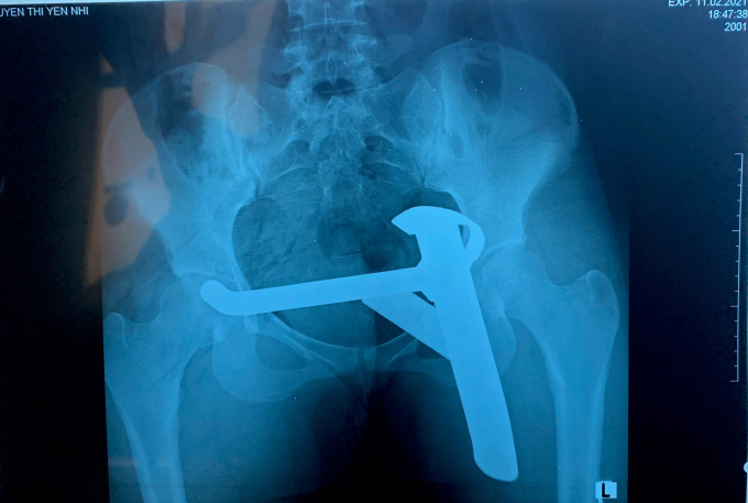 Hình ảnh chân chống xe đâm dính vào vùng mông bệnh nhân trên phim X-quang. Ảnh: BVCC.