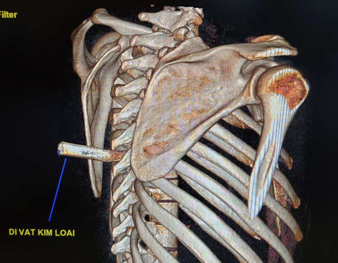 Hình dị vật kim loại trên phim CT của bệnh nhân. Ảnh: BVCC.