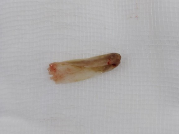 Các bác sĩ đã dùng kềm lấy được dị vật là 1 chiếc xương cá khoảng 3cm ra khỏi người bệnh nhân nữ H. T. T., 62 tuổi, ở huyện Đông Hải (Bạc Liêu). Ảnh: BVCC.