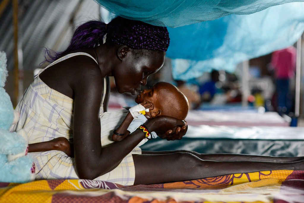 Một người mẹ ở Nam Sudan hôn con của cô khi đứa bé đang bị suy dinh dưỡng cấp tính nặng có thể gây biến chứng, trong đó có bệnh lao. Ảnh: UNICEF / Sebastian Rich