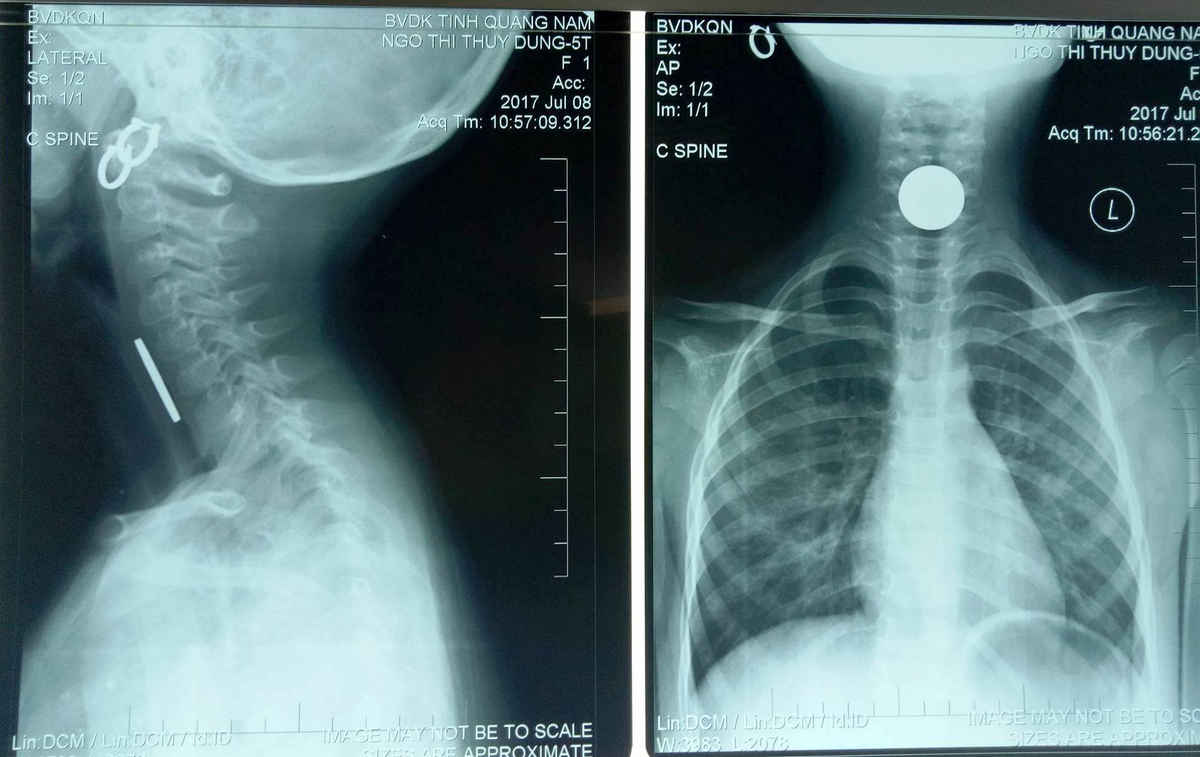 Kết quả chụp XQ vùng cổ cháu Vy phát hiện dị vật