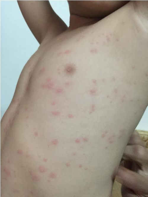 Người dân và du khách cho biết đã bị ngứa ngáy, nổi mẩn đỏ khắp người khi tắm biển Đà Nẵng