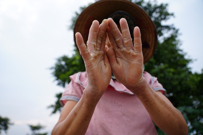 z5688963904252_54bb9584c4d620af606fd2f8e53826f2-152210_800.jpg Người dân xóm Bến Vôi, xã Cấn Hữu (huyện Quốc Oai) bị nước ăn tay do tiếp xúc với nước nhiều. Ảnh: Hùng Khang.