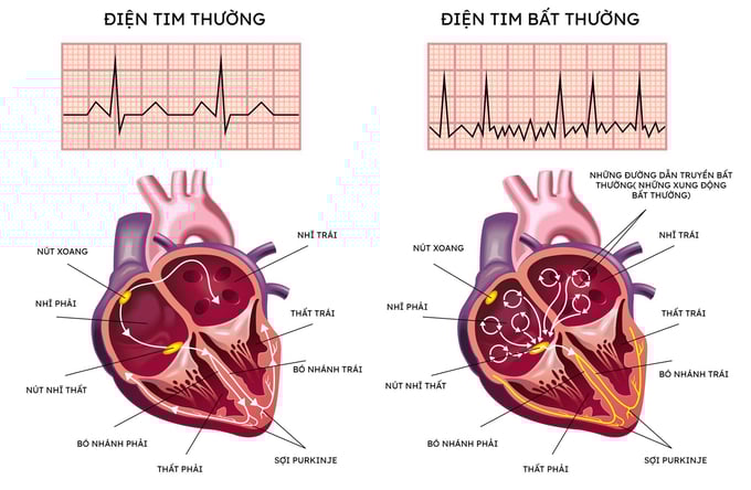 rung-nhi-115121_150.jpg Rung nhĩ là rối loạn nhịp tim thường gặp nhất. Bệnh nhân mắc rung nhĩ có nguy cơ đột quỵ cao gấp 5 lần người bình thường.