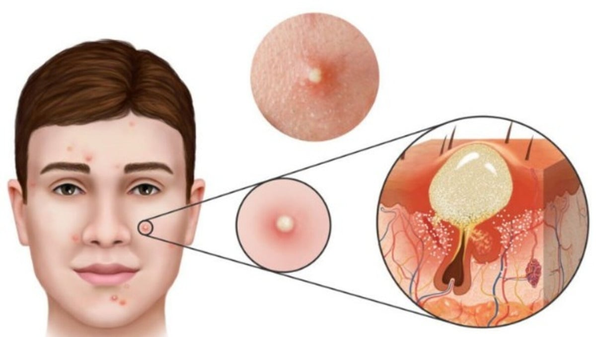 Mụn trứng cá có nhiều nguyên nhân và nhiều triệu chứng khác nhau. Mụn trứng cá có nhiều nguyên nhân và nhiều triệu chứng khác nhau.