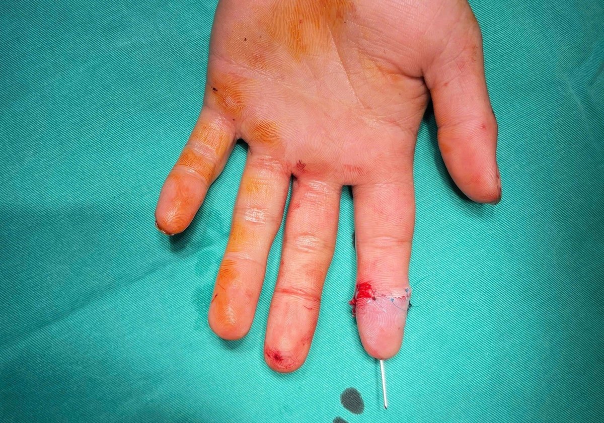 Ngón trỏ bệnh nhân hồi phục tích cực sau 14 ngày phẫu thuật. Ảnh: Bệnh viện Bệnh Nhiệt đới Trung ương. Ngón trỏ bệnh nhân hồi phục tích cực sau 14 ngày phẫu thuật. Ảnh: Bệnh viện Bệnh Nhiệt đới Trung ương.