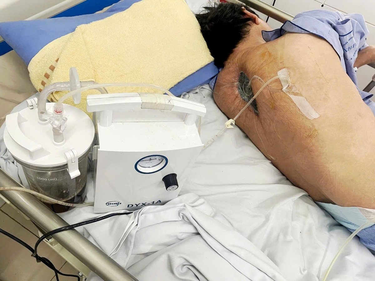 Sau ba tuần đặt VAC, xét nghiệm dịch hút vùng đốt sống cổ ngực cho thấy bệnh nhân không còn nhiễm nấm, các dấu hiệu nhiễm trùng đã được kiểm soát. Ảnh: Bệnh viện Bệnh Nhiệt đới Trung ương. Sau ba tuần đặt VAC, xét nghiệm dịch hút vùng đốt sống cổ ngực cho thấy bệnh nhân không còn nhiễm nấm, các dấu hiệu nhiễm trùng đã được kiểm soát. Ảnh: Bệnh viện Bệnh Nhiệt đới Trung ương.