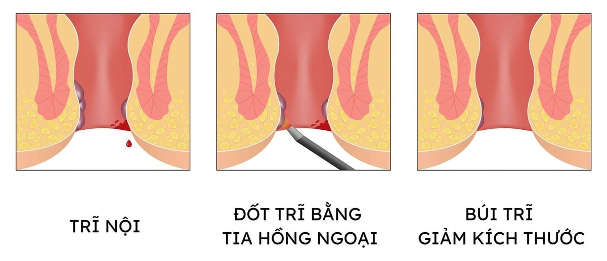 Mô phỏng trước và sau khi điều trị trĩ nội bằng tia laser. Mô phỏng trước và sau khi điều trị trĩ nội bằng tia laser.