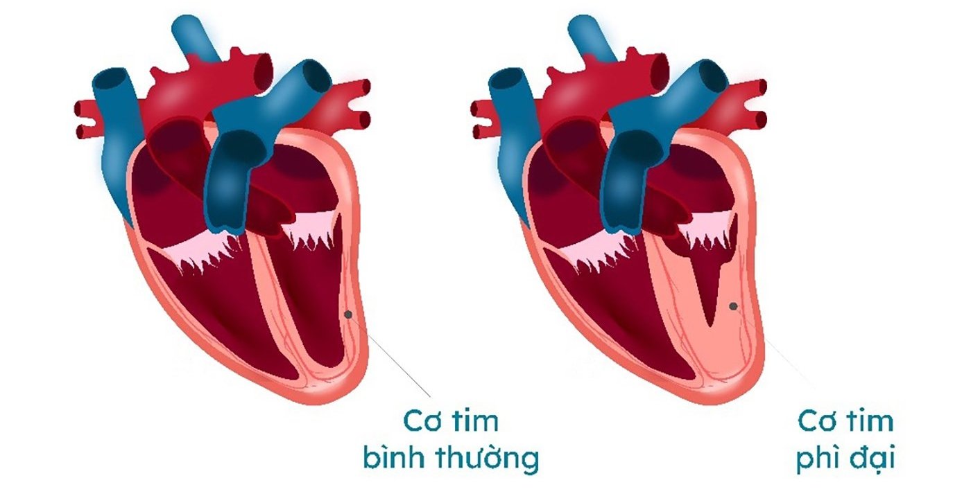 Minh họa cơ tim bình thường và cơ tim phì đại.