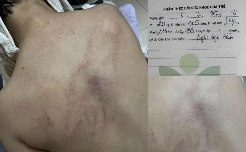 Hình ảnh bầm tím ở lưng bé T.K.L nghi bị cô giáo bạo hành. Ảnh: TL. Hình ảnh bầm tím ở lưng bé T.K.L nghi bị cô giáo bạo hành. Ảnh: TL.