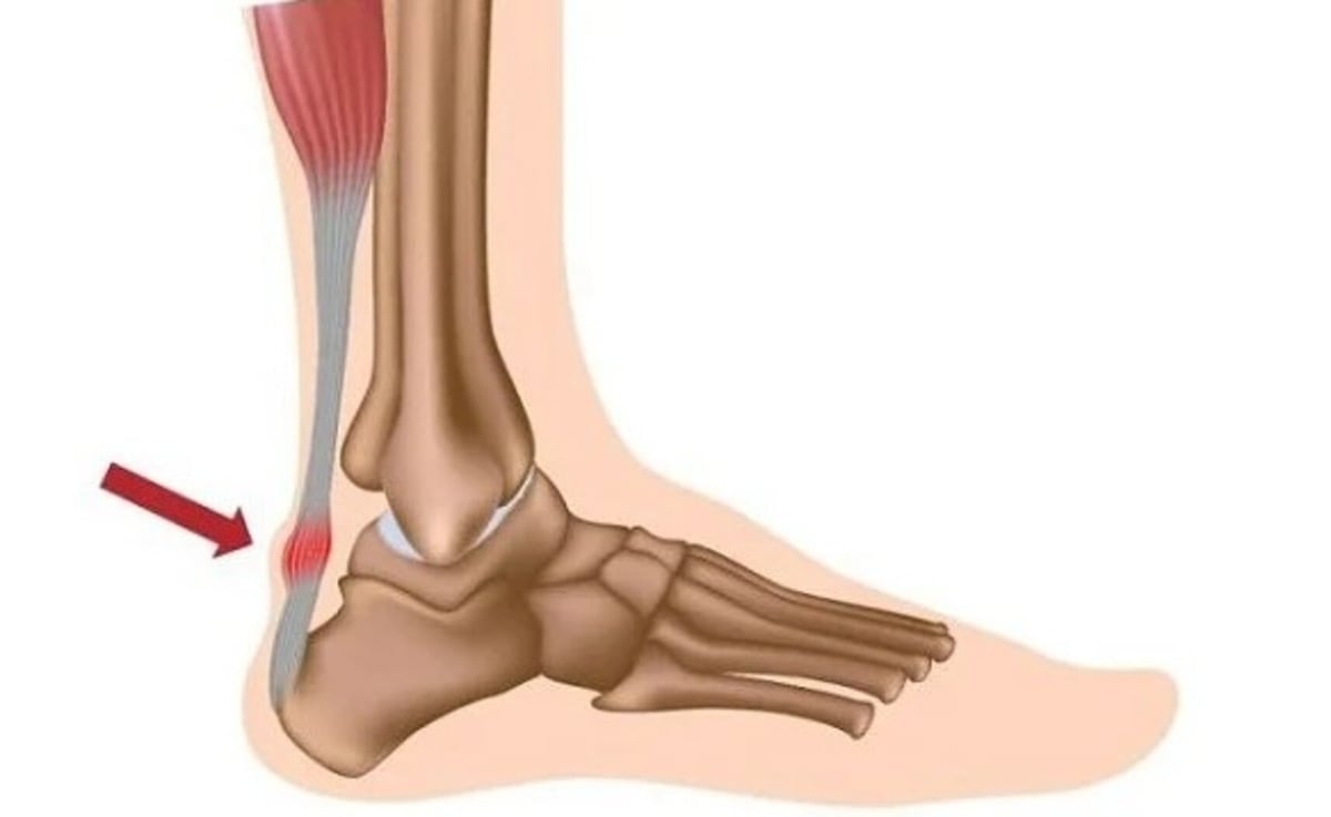 Vị trí đứt gân gót chân khá phổ biến. Ảnh: TL.