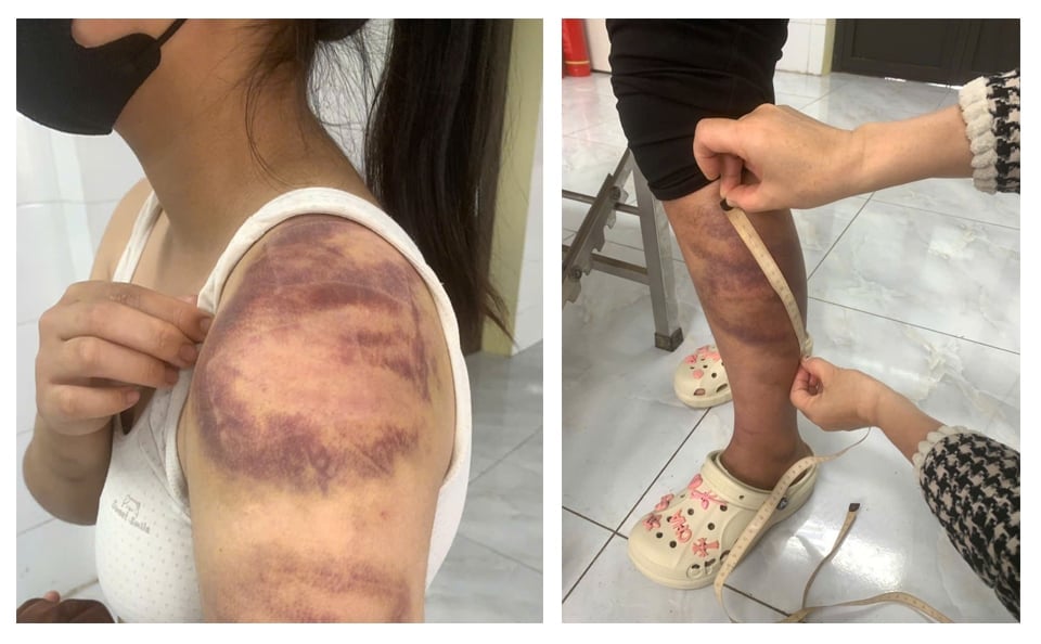 Nhưng vết thương của cháu T. do bị bố đẻ đánh. Ảnh: Công an tỉnh Bắc Ninh.