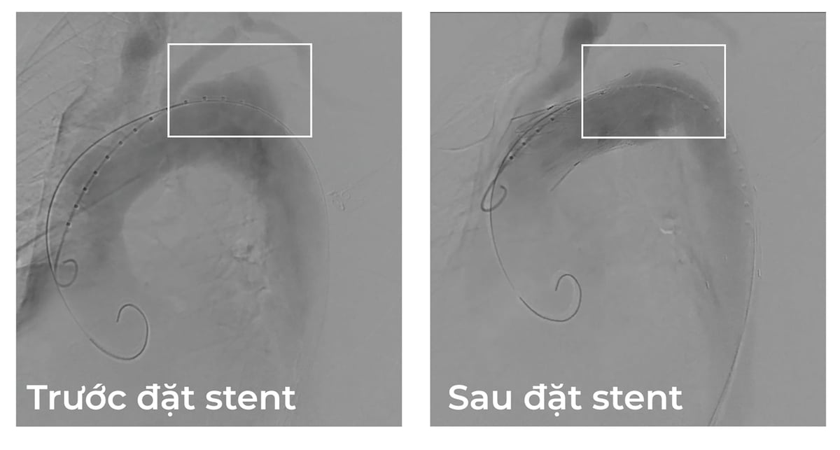 Hình ảnh trước và sau khi đặt stent graft che phủ vị trí động mạch chủ bị vỡ để ngăn chảy máu. Ảnh: Lê Khoa.