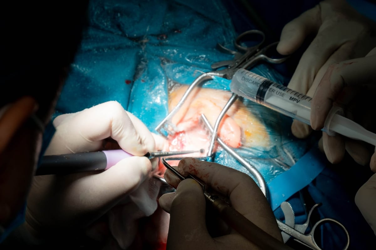Ca phẫu thuật thành công, không chỉ mang ý nghĩa đối với riêng bệnh nhi mà còn mở ra cơ hội điều trị cho nhiều trẻ điếc bẩm sinh khác. Ảnh: BVNHN.