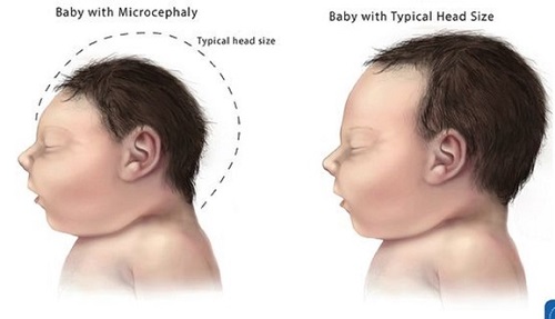 nhung-dieu-can-biet-ve-virus-zika-gay-teo-nao-tre-so-sinh