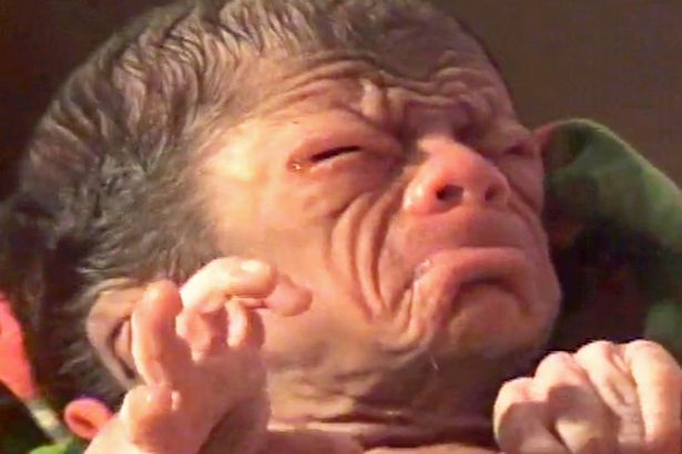 Em bé bị bệnh lạ, Em bé già như lão 80, em bé mắc bệnh lão hóa