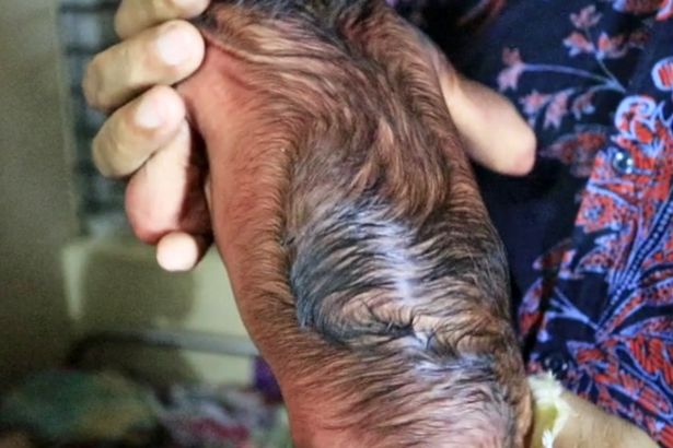 Em bé bị bệnh lạ, Em bé già như lão 80, em bé mắc bệnh lão hóa